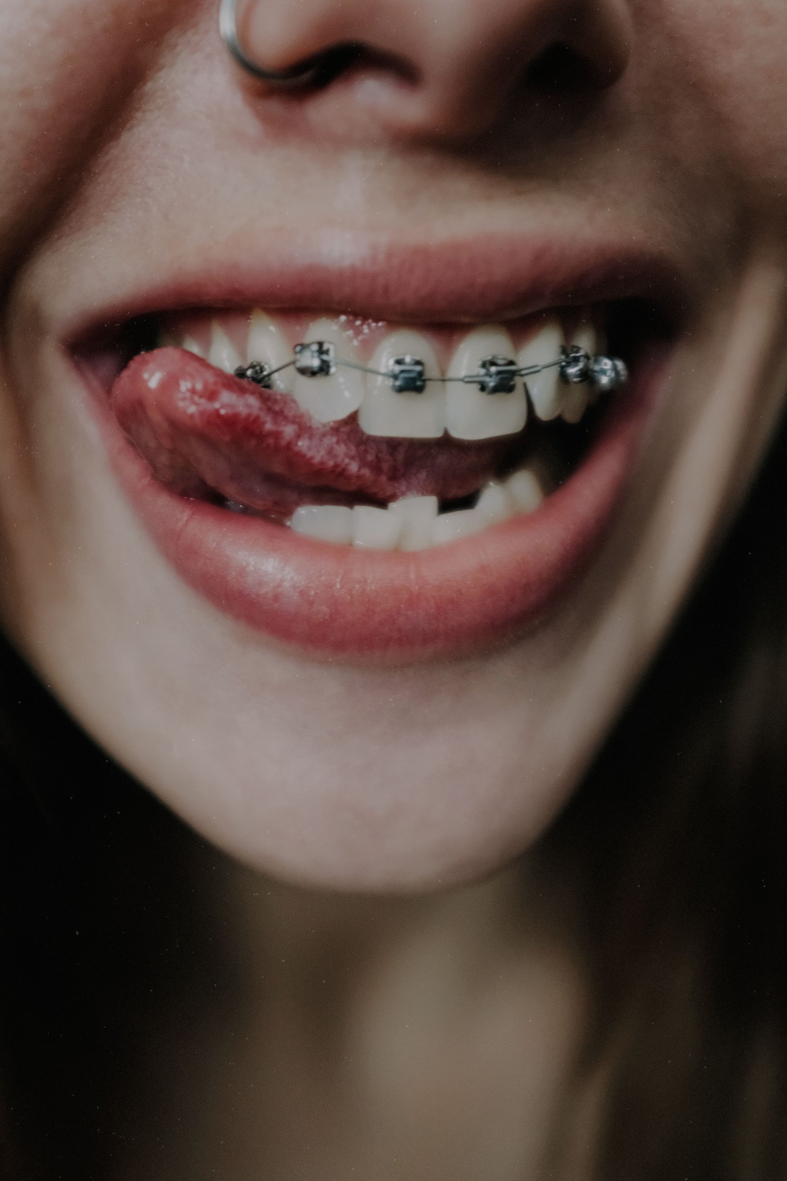 Ortodoncia tradicional con brackets